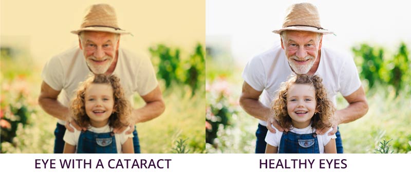 Chart Showing What it's like to see with a cataract vs without a cataract